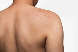 Skin rash